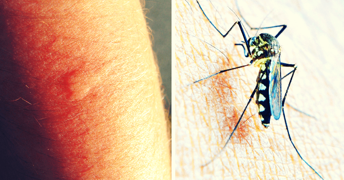 7 razones por por las que siempre te pican a ti los mosquitos
